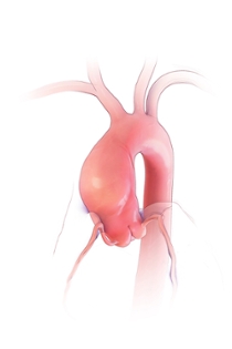 aortic-aneurysm