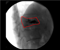 Vertebroplasty cement in fractured vertebra after injection