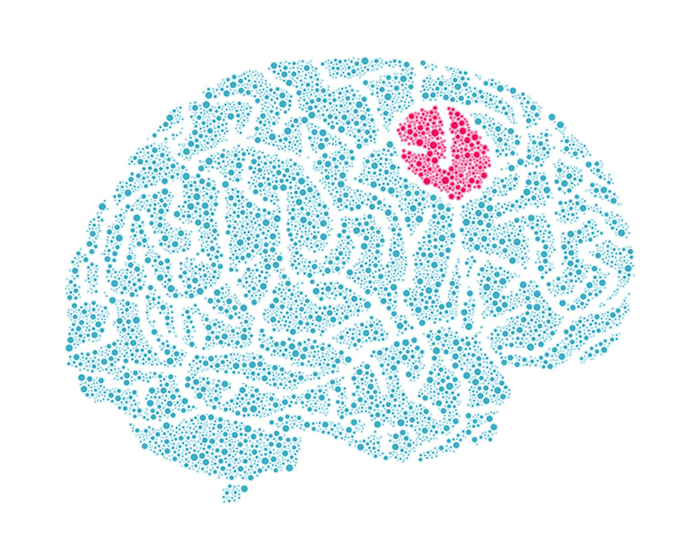 An illustration of a brain with an injury