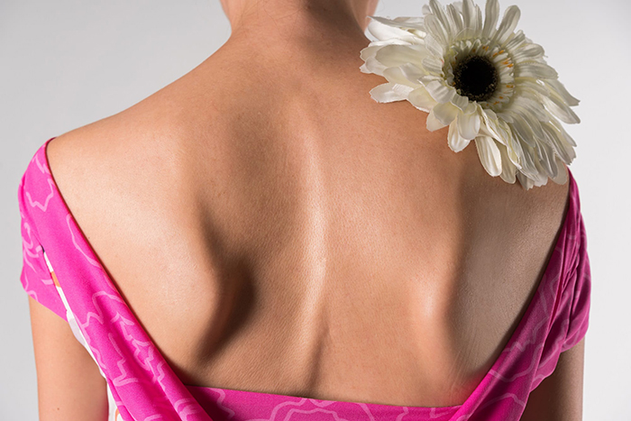 scoliosis
