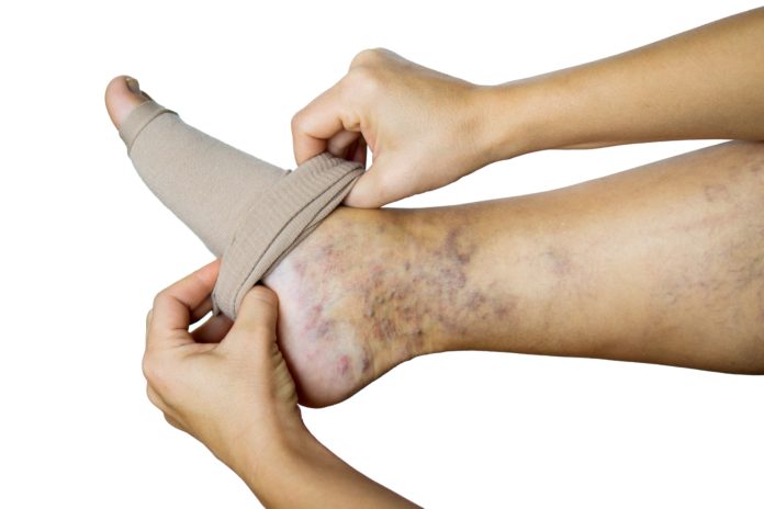 Person putting on a compression sock