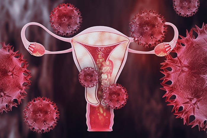 Risk of Gynecologic Cancer