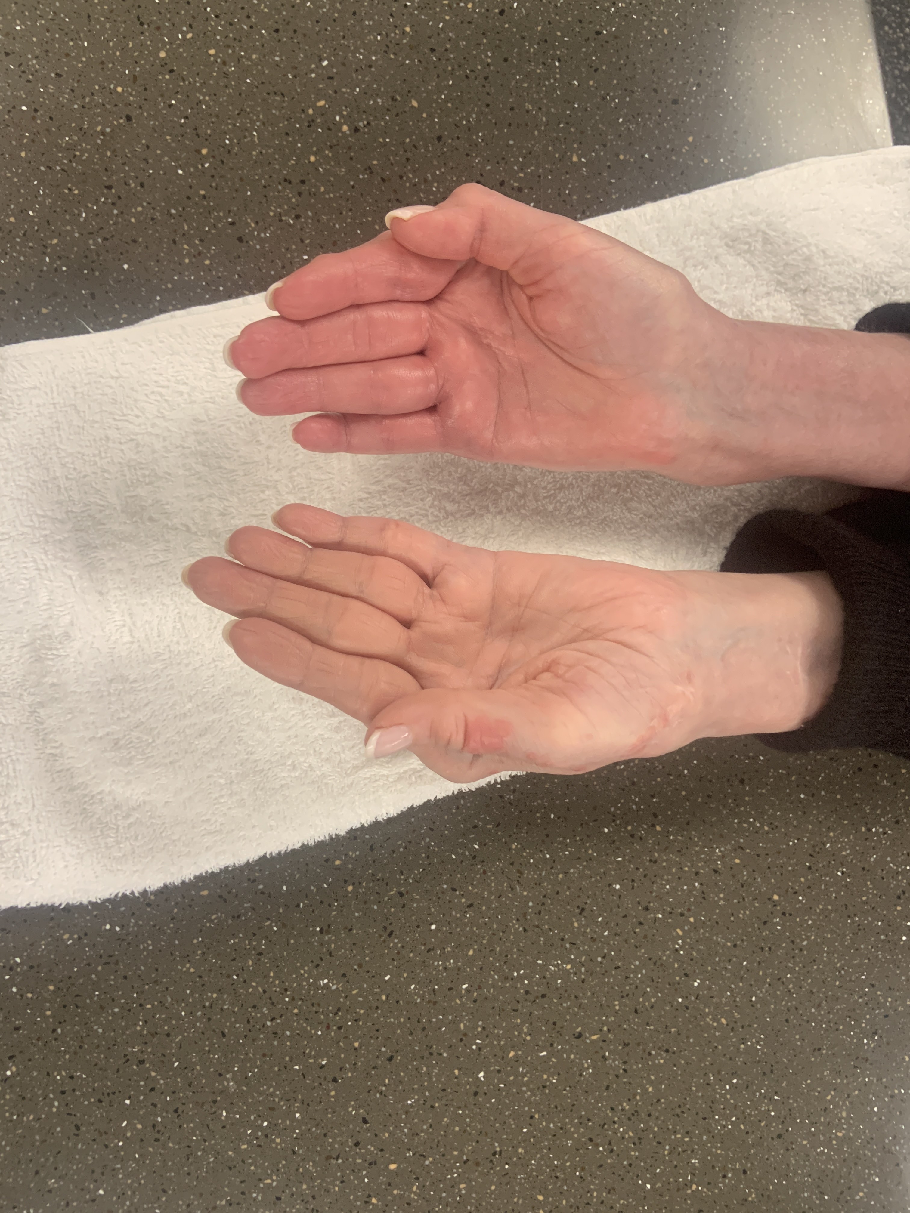 Rheumatology patient hands post surgery