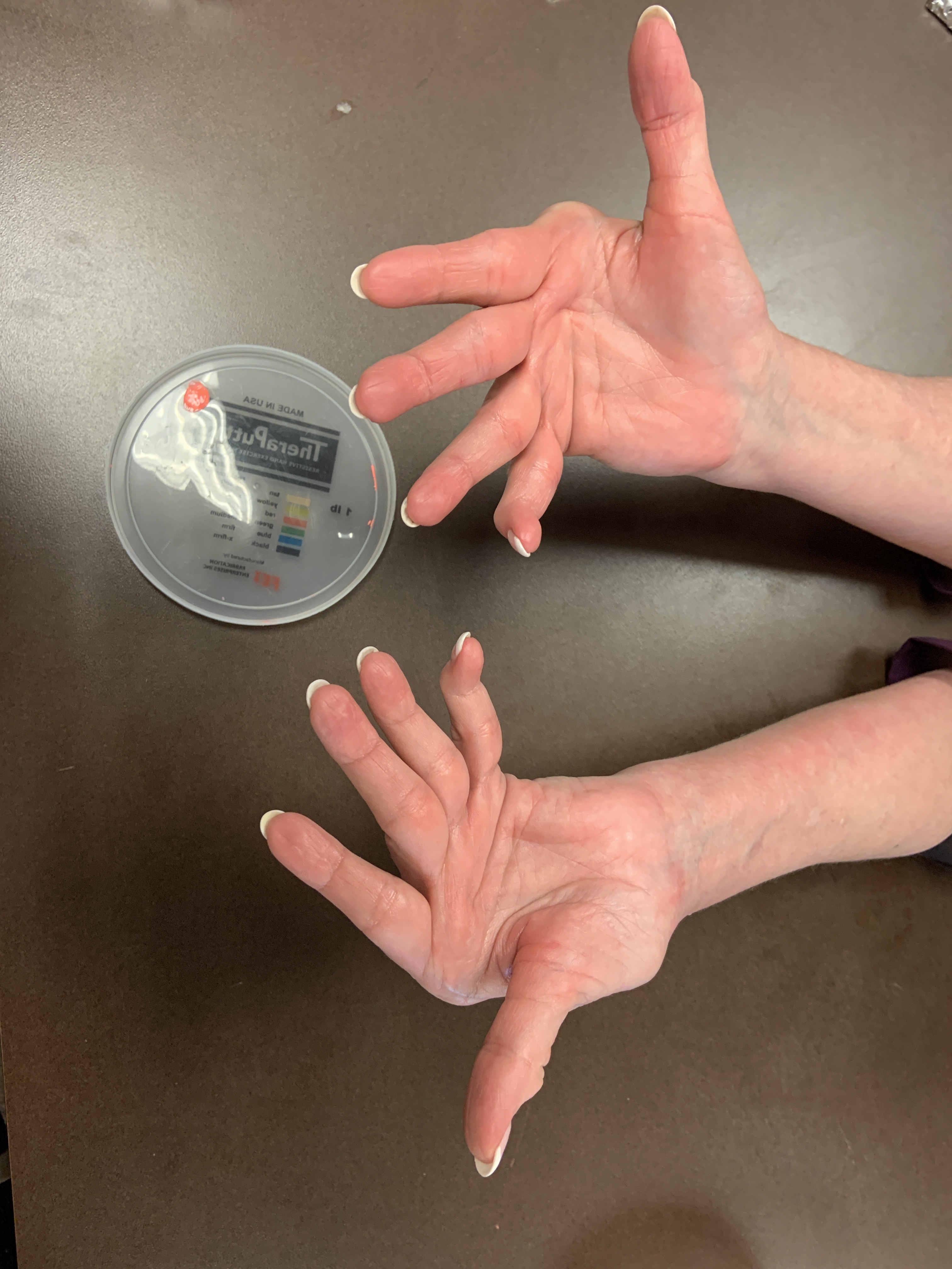 rheumatology patient hands pre-surgery