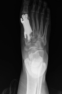 X-ray shows a 3-D printed bone implant in foot