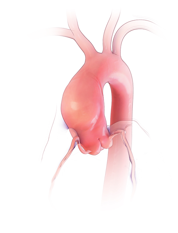 Aortic Aneurysm