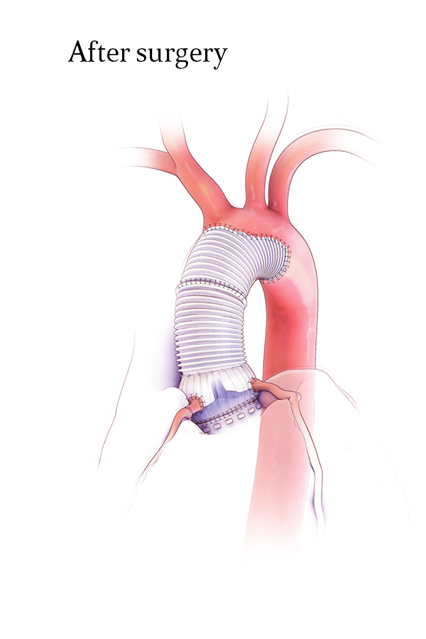 Mechanical Composite Root with Hemiarch Replacement