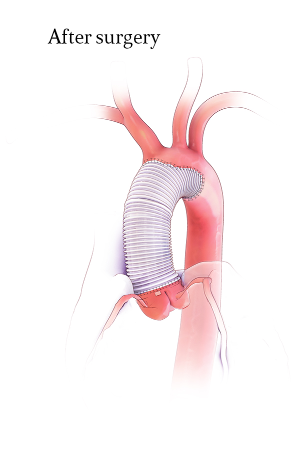 Aortic Valve Resuspension