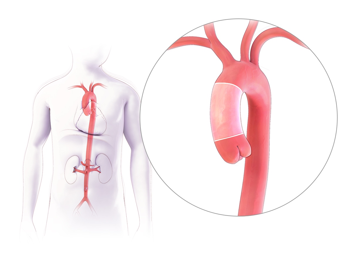 Ascending Aorta Anatomy Descending Thoracic Aorta Replacement