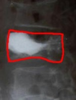 Compression fracture after Kyphoplasty
