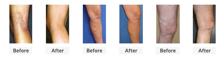 Vein Center Before and After