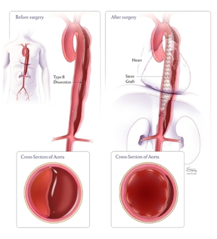 Surgical Treatment of Aortic Dissection