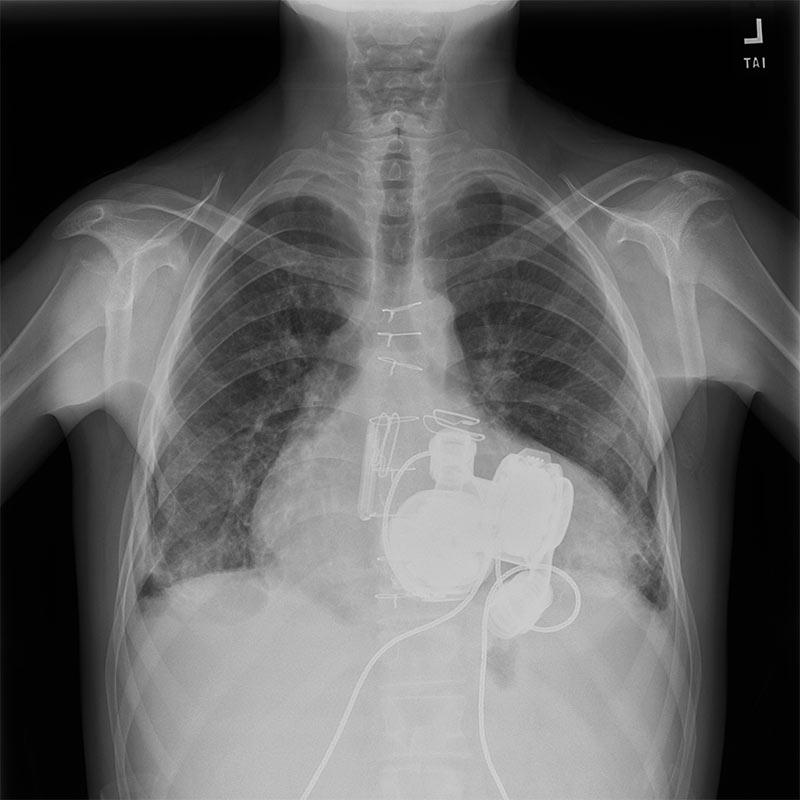 Double Vad Chest X-ray