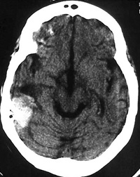 CT scan shows bleeding on inside of brain