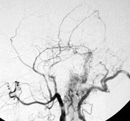 original angiogram showing the fistula