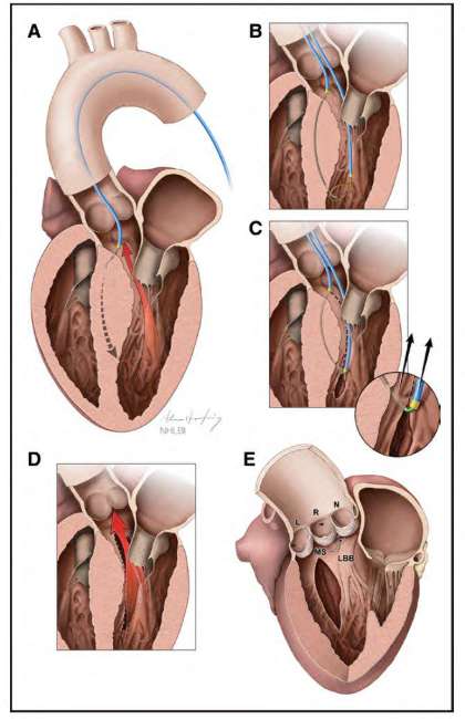 illustration of Septal Scoring Along the Midline Endocardium procedure