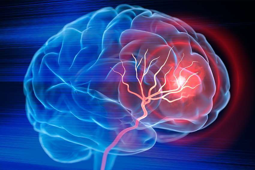 blue graphic of a human brain with red veins depicting a hemmorrage