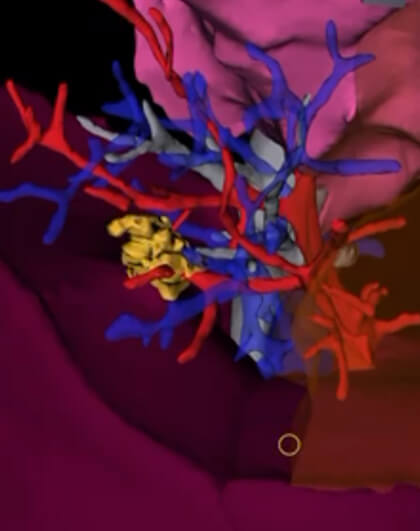 a three-dimensional, colorful rendering of a patient's lung