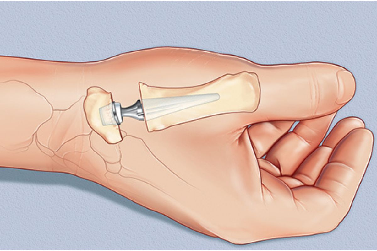 Emory Healthcare first in Georgia and the Southeast to offer total thumb arthroplasty for advanced thumb arthritis