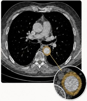 heart scan periarortic fat