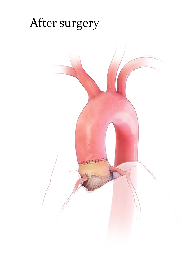 Porcine Bioroot Replacement