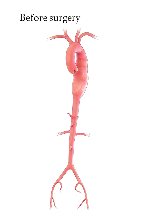 TEVAR Extent A Repair